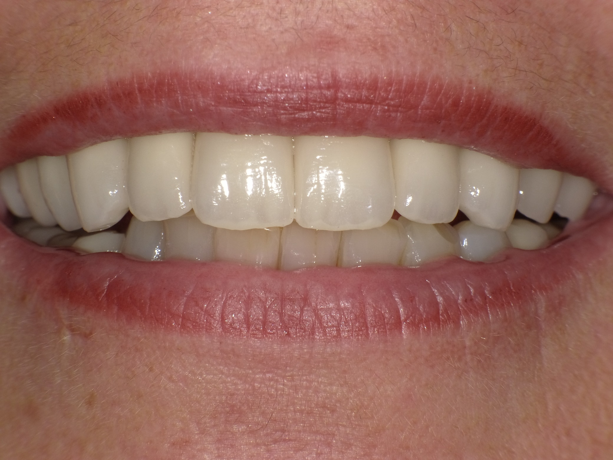 Optimierung von Zähnen und Zahnleisch mit Vollkeramik